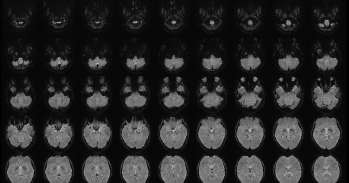 Cientista traduz pensamentos em palavras usando ressonância magnética