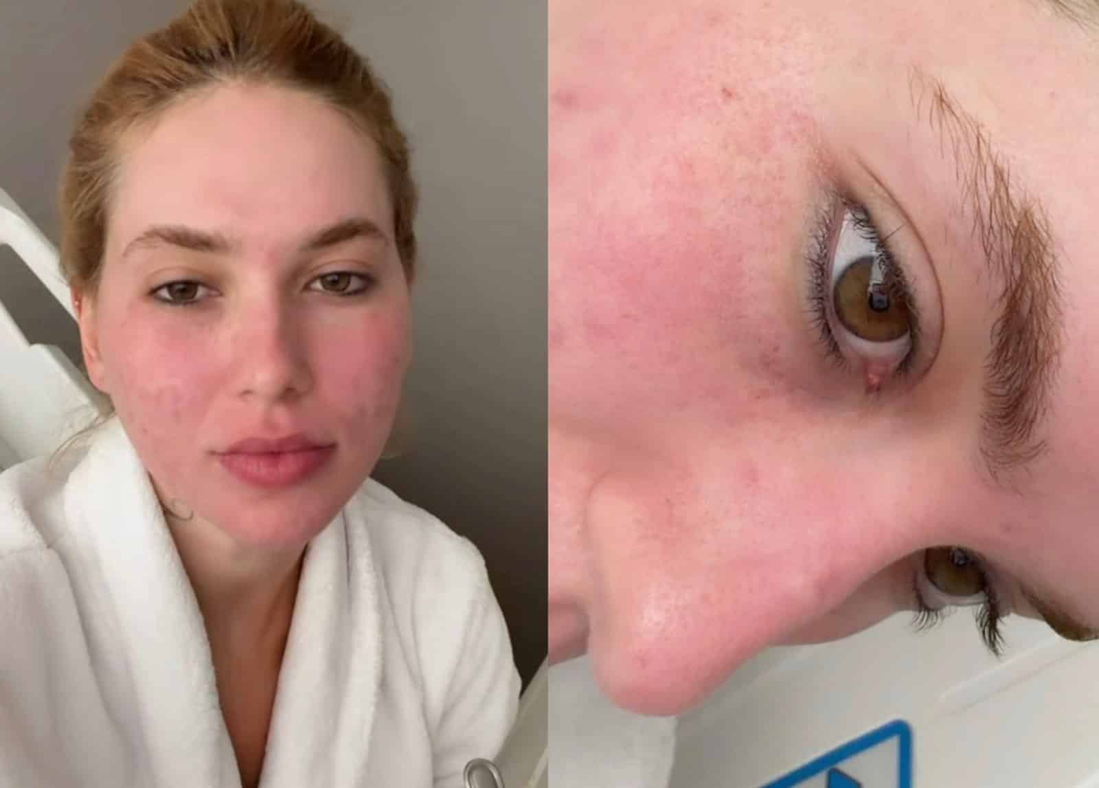 entenda o que é o laser de CO₂ profundo, tratamento feito pela influenciadora