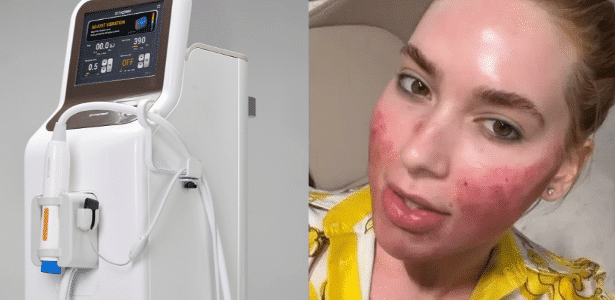 Equipamento 10therma, utilizado em procedimento estético que causou vermelhidão no rosto de Virgínia Fonseca, foi aprovado no Brasil em 2025 pela Anvisa