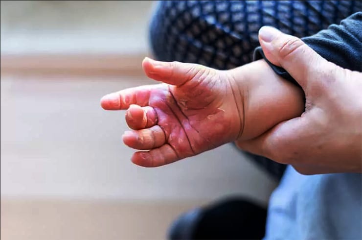 A Redação | Goiás registra o 3º maior número de internações por queimaduras infantis no país